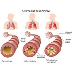 Asthma